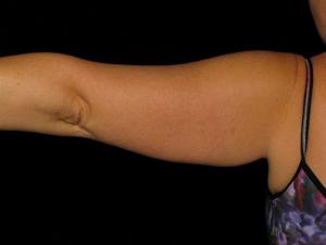 Pre-operative patient photo for Arm Lift at Restora Austin Plastic Surgery Centre in Austin, TX
