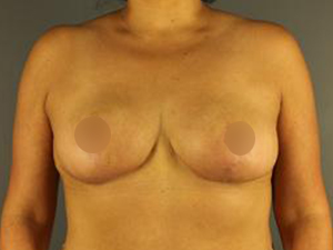 After Breast Lift ,Patient photo at Restora Austin Plastic Surgery Centre, Austin, TX