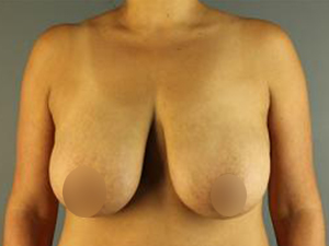 Before Breast Lift ,Patient photo at Restora Austin Plastic Surgery Centre, Austin, TX