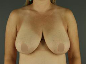 Patient before Breast Lift at Restora Austin Plastic Surgery Centre in Austin, TX