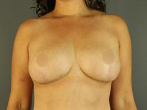 Post-operative patient photo for Breast Lift at Restora Austin Plastic Surgery Centre in Austin, TX