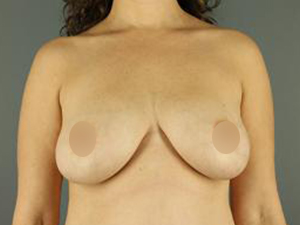 Pre-operative patient photo for Breast Lift at Restora Austin Plastic Surgery Centre in Austin, TX