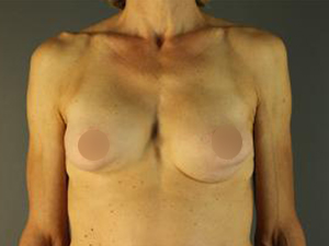 Before Breast Implant Revision ,Patient photo at Restora Austin Plastic Surgery Centre, Austin, TX