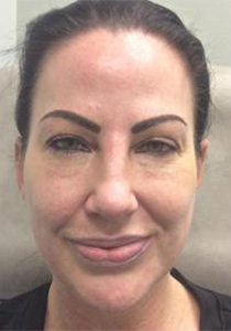 Patient after Neurotoxin at Restora Austin Plastic Surgery Centre in Austin, TX