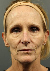 Before FaceLift , Patient photo at Restora Austin Plastic Surgery Centre, Austin, TX