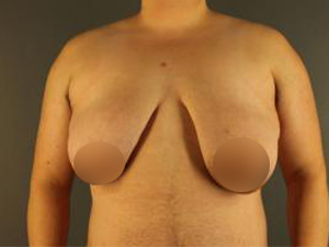 Patient before FTM Top Surgery at Restora Austin Plastic Surgery Centre in Austin, TX