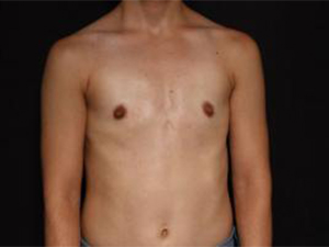 Post-operative patient photo for FTM Top Surgery at Restora Austin Plastic Surgery Centre in Austin, TX