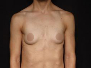 Pre-operative patient photo for FTM Top Surgery at Restora Austin Plastic Surgery Centre in Austin, TX