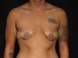 Before FTM Top Surgery ,Patient photo at Restora Austin Plastic Surgery Centre, Austin, TX