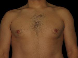 Post-operative patient photo for Gynecomastia procedure at Restora Austin Plastic Surgery Centre in Austin, TX