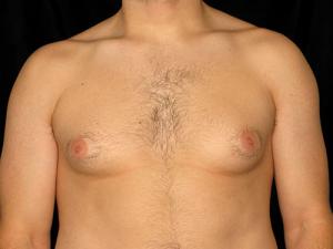 Pre-operative patient photo for Gynecomastia procedure at Restora Austin Plastic Surgery Centre in Austin, TX