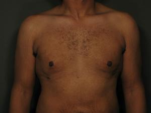 Patient after Gynecomastia at Restora Austin Plastic Surgery Centre in Austin, TX