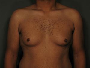 Patient before Gynecomastia at Restora Austin Plastic Surgery Centre in Austin, TX