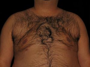 A patient after undergoing Gynecomastia at Restora Austin Plastic Surgery Centre, Austin, TX