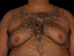 A patient before undergoing Gynecomastia at Restora Austin Plastic Surgery Centre, Austin, TX