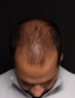 Post-operative patient photo for Hair Restoration at Restora Austin Plastic Surgery Centre in Austin, TX