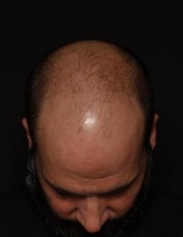Pre-operative patient photo for Hair Restoration at Restora Austin Plastic Surgery Centre in Austin, TX