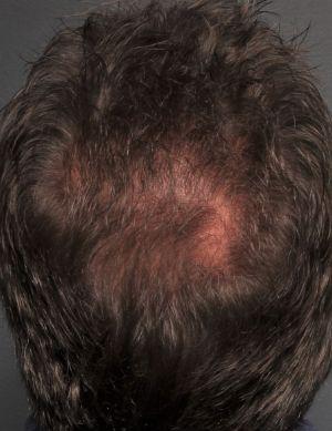 A patient after undergoing Hair Restoration at Restora Austin Plastic Surgery Centre, Austin, TX