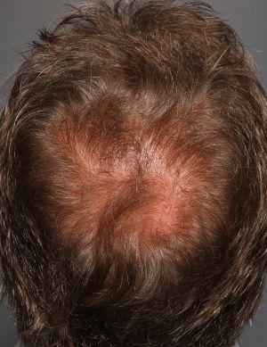 Before undergoing Hair Restoration , Patient photo at Restora Austin Plastic Surgery Centre, Austin, TX