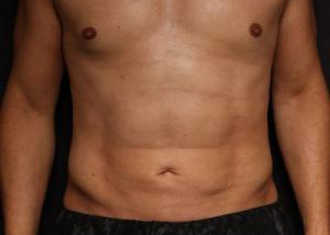 Patient after VASER Hi-Def Liposuction at Restora Austin Plastic Surgery Centre in Austin, TX