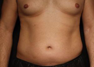 Patient before VASER Hi-Def Liposuction at Restora Austin Plastic Surgery Centre in Austin, TX