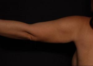 Post-operative patient photo for VASER Hi-Def Liposuction at Restora Austin Plastic Surgery Centre in Austin, TX