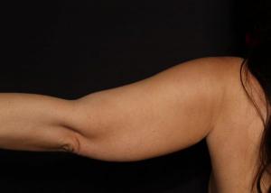 Pre-operative patient photo for VASER Hi-Def Liposuction at Restora Austin Plastic Surgery Centre in Austin, TX