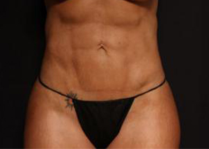 After VASER Hi-Def Liposuction,Patient photo at Restora Austin Plastic Surgery Centre, Austin, TX
