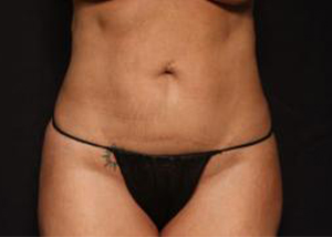 Before VASER Hi-Def Liposuction, Patient photo at Restora Austin Plastic Surgery Centre, Austin, TX