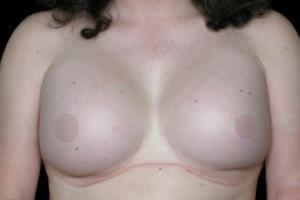 After MTF Top Surgery ,Patient photo at Restora Austin Plastic Surgery Centre, Austin, TX