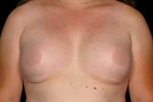 Post-operative patient photo for MTF Top Surgery at Restora Austin Plastic Surgery Centre in Austin, TX