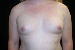 Pre-operative patient photo for MTF Top Surgery at Restora Austin Plastic Surgery Centre in Austin, TX