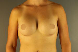 Patient after MTF Top Surgery at Restora Austin Plastic Surgery Centre in Austin, TX