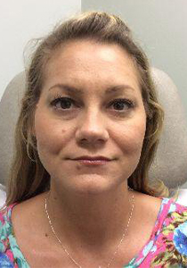 Before undergoing Dermal Fillers , Patient photo at Restora Austin Plastic Surgery Centre, Austin, TX