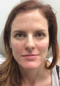 Post-operative patient photo for Neurotoxin at Restora Austin Plastic Surgery Centre in Austin, TX