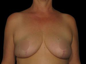 After Breast Reduction ,Patient photo at Restora Austin Plastic Surgery Centre, Austin, TX