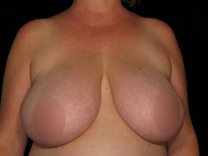 Before Breast Reduction ,Patient photo at Restora Austin Plastic Surgery Centre, Austin, TX