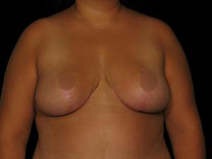Patient after Breast Reduction at Restora Austin Plastic Surgery Centre in Austin, TX