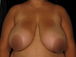 Patient before Breast Reduction at Restora Austin Plastic Surgery Centre in Austin, TX
