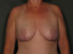 Post-operative patient photo for Breast Reduction at Restora Austin Plastic Surgery Centre in Austin, TX
