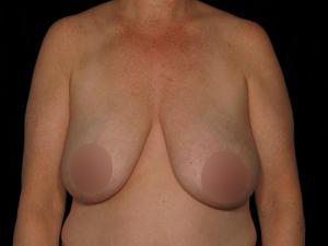 Pre-operative patient photo for Breast Reduction at Restora Austin Plastic Surgery Centre in Austin, TX