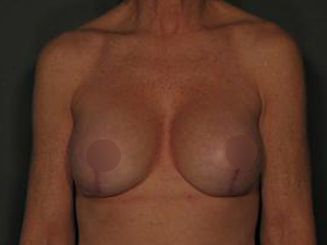 Patient after Breast Implant Revision at Restora Austin Plastic Surgery Centre in Austin, TX