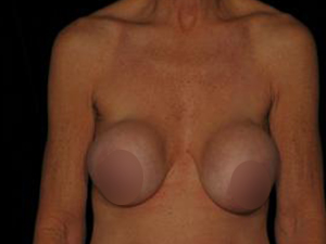 Patient before Breast Implant Revision at Restora Austin Plastic Surgery Centre in Austin, TX