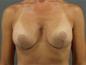 Post-operative patient photo for Breast Implant Revision at Restora Austin Plastic Surgery Centre in Austin, TX