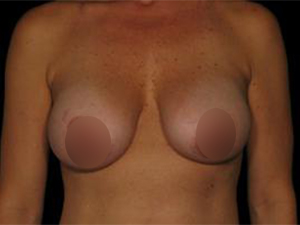 Pre-operative patient photo for Breast Implant Revision at Restora Austin Plastic Surgery Centre in Austin, TX