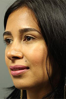 Patient after Rhinoplasty at Restora Austin Plastic Surgery Centre in Austin, TX