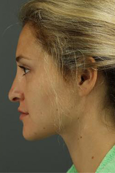 Before Rhinoplasty , Patient photo at Restora Austin Plastic Surgery Centre, Austin, TX