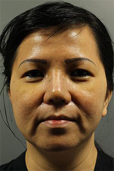 Post-operative patient photo for Rhinoplasty at Restora Austin Plastic Surgery Centre in Austin, TX
