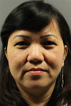Pre-operative patient photo for Rhinoplasty at Restora Austin Plastic Surgery Centre in Austin, TX