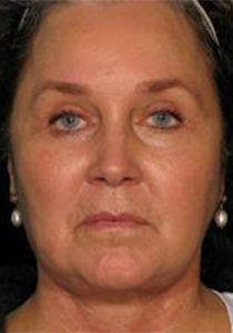 Post-operative patient photo for FaceLift at Restora Austin Plastic Surgery Centre in Austin, TX